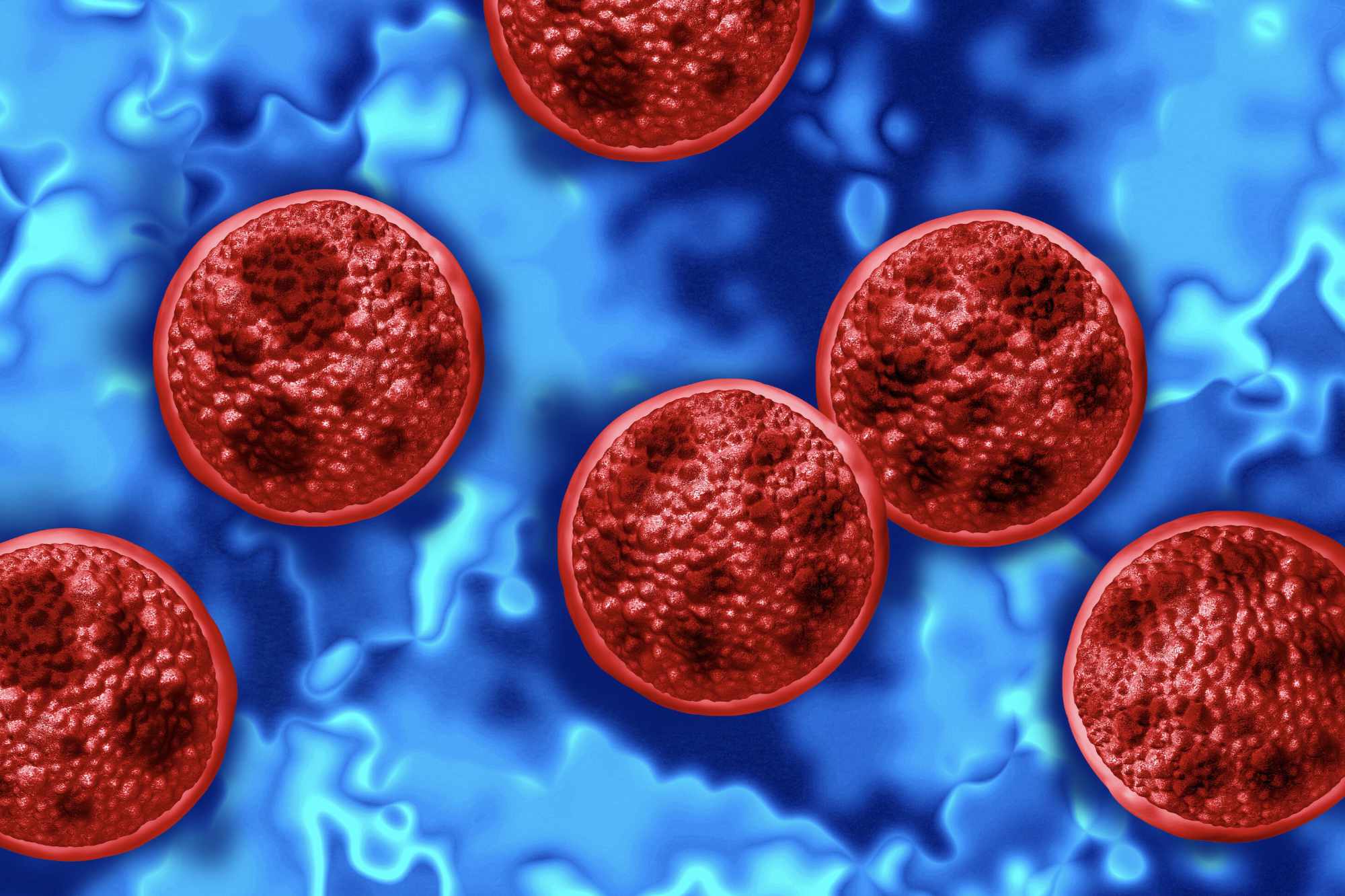 Cyclosporiasis is caused by Cyclospora cayetanensis, a microscopic parasite that infects the small intestine. 